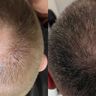 hair loss treatment Dallas TX